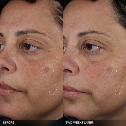 Topicals 
Faded Tranexamic Acid Dark Spot Patches for Hyperpigmentation
