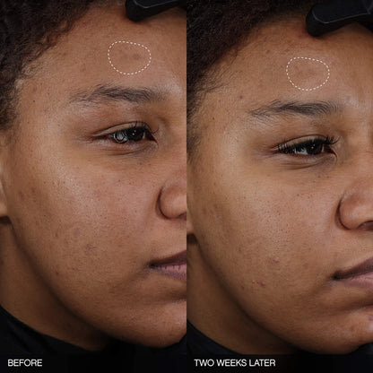 Topicals 
Faded Tranexamic Acid Dark Spot Patches for Hyperpigmentation