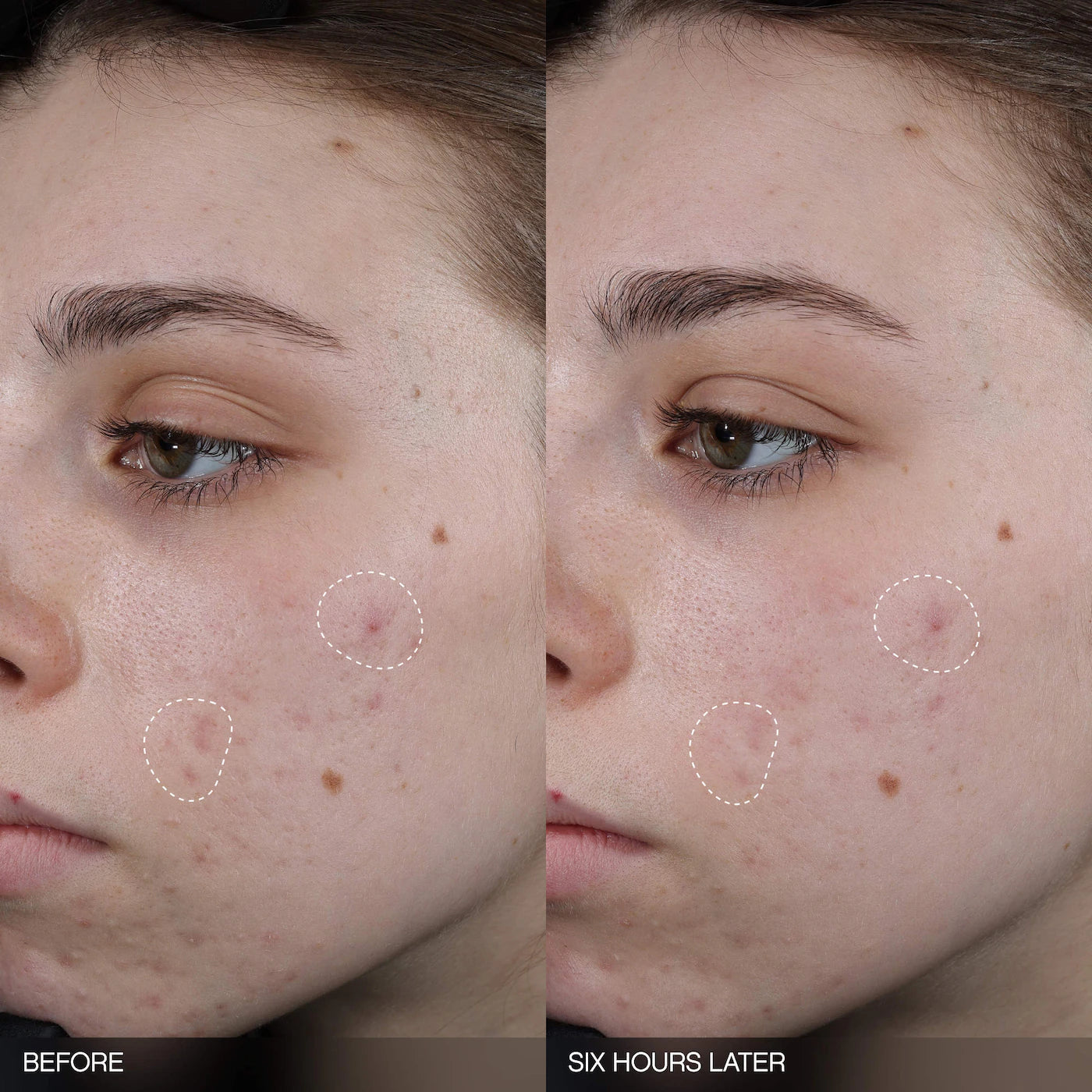 Topicals 
Faded Tranexamic Acid Dark Spot Patches for Hyperpigmentation