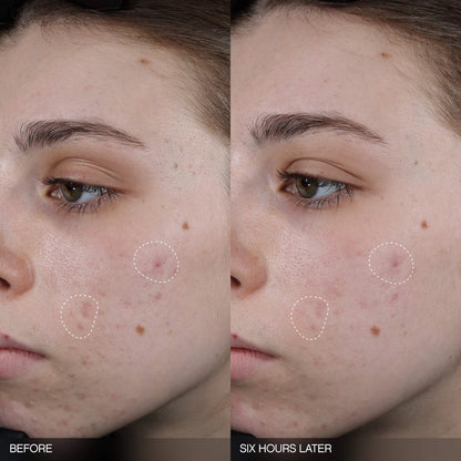 Topicals 
Faded Tranexamic Acid Dark Spot Patches for Hyperpigmentation