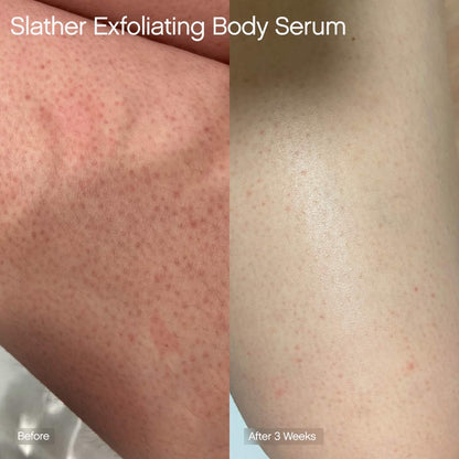 Topicals 
Slather Exfoliating Body Serum with Retinol and AHAs