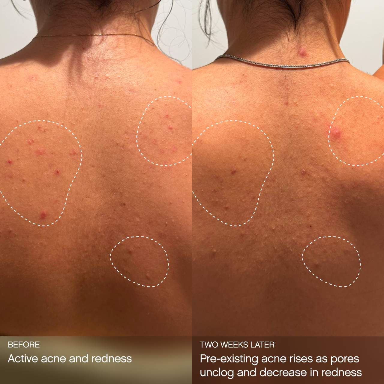 Topicals 
Clearly Clarifying & Calming Mist For Acne-Prone Skin