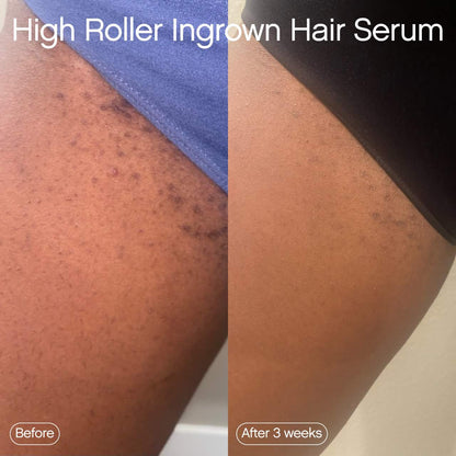 Topicals 
High Roller Ingrown Hair Tonic with AHA and BHA